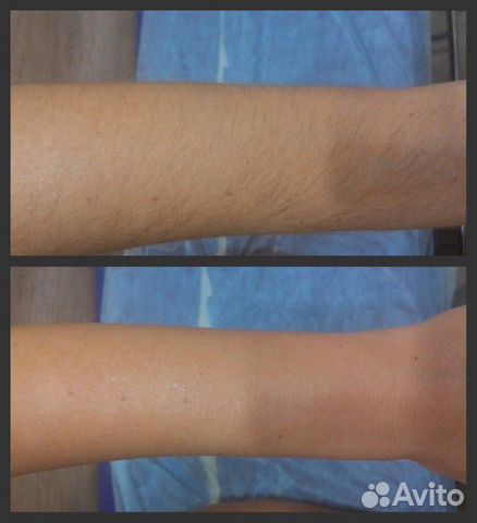 Депиляция шугаринг, воск Депиляция шугаринг, воск