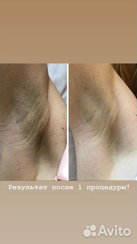 Лазерная эпиляция Лазерная эпиляция