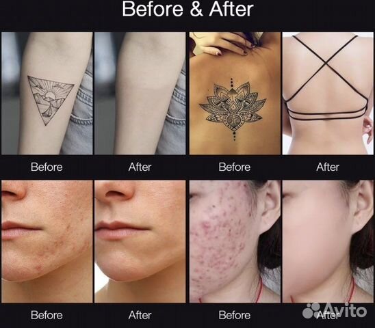 Лазерная ручка для удаление