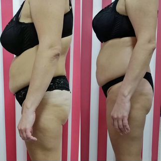 Антицеллюлитный вакуумный массаж, RF лифтинг